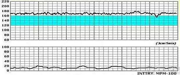 胎心监护的重要性及其适宜时间
